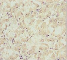 EFHC1 Antibody - Immunohistochemistry of paraffin-embedded human gastric cancer at dilution 1:100