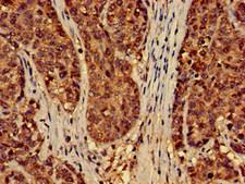 EFHD2 Antibody - Immunohistochemistry of paraffin-embedded human ovarian cancer at dilution of 1:100