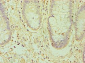EFNA1 / Ephrin A1 Antibody - Immunohistochemistry of paraffin-embedded human rectal cancer using antibody at 1:100 dilution.