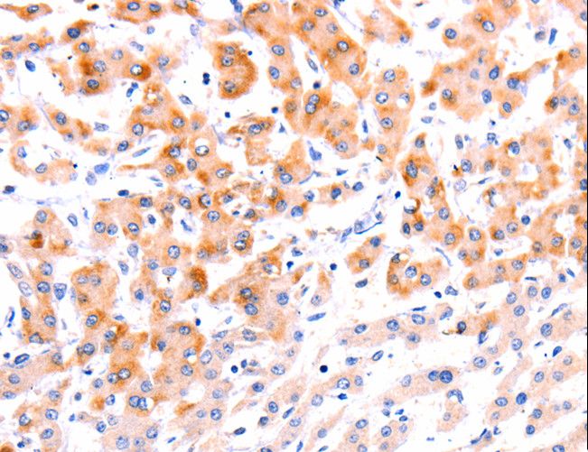 EFNA1 / Ephrin A1 Antibody - Immunohistochemistry of paraffin-embedded Human thyroid cancer using EFNA1 Polyclonal Antibody at dilution of 1:37.