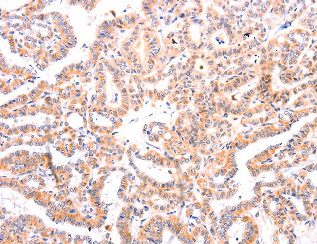 EFNA1 / Ephrin A1 Antibody - Immunohistochemistry of paraffin-embedded Human thyroid cancer using EFNA1 Polyclonal Antibody at dilution of 1:37.