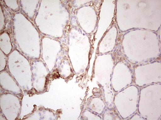 EFNA3 / Ephrin A3 Antibody - Immunohistochemical staining of paraffin-embedded Human thyroid tissue within the normal limits using anti-EFNA3 mouse monoclonal antibody. (Heat-induced epitope retrieval by 1 mM EDTA in 10mM Tris, pH8.5, 120C for 3min,