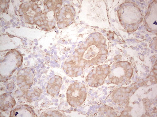 EFNA3 / Ephrin A3 Antibody - Immunohistochemical staining of paraffin-embedded Adenocarcinoma of Human breast tissue using anti-EFNA3 mouse monoclonal antibody. (Heat-induced epitope retrieval by 1 mM EDTA in 10mM Tris, pH8.5, 120C for 3min,
