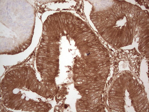 EFNA3 / Ephrin A3 Antibody - Immunohistochemical staining of paraffin-embedded Adenocarcinoma of Human colon tissue using anti-EFNA3 mouse monoclonal antibody. (Heat-induced epitope retrieval by 1 mM EDTA in 10mM Tris, pH8.5, 120C for 3min,