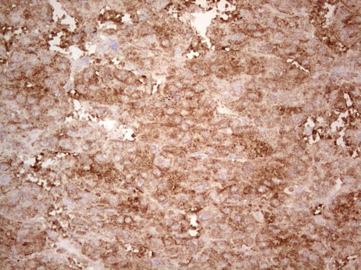 EFNA3 / Ephrin A3 Antibody - Immunohistochemical staining of paraffin-embedded Carcinoma of Human liver tissue using anti-EFNA3 mouse monoclonal antibody. (Heat-induced epitope retrieval by 1 mM EDTA in 10mM Tris, pH8.5, 120C for 3min,