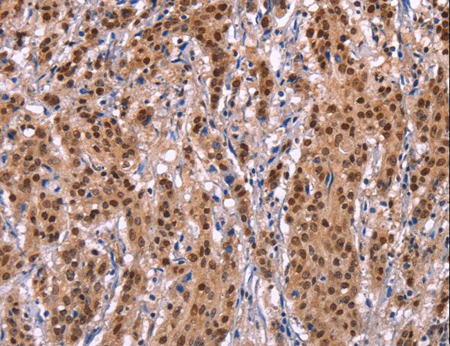 EFNA5 / Ephrin A5 Antibody - Immunohistochemistry of paraffin-embedded Human gastric cancer using EFNA5 Polyclonal Antibody at dilution of 1:40.