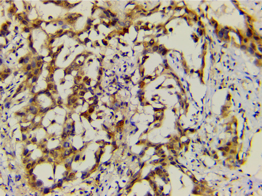 EFNB2 / Ephrin B2 Antibody - 1:200 staining human lung carcinoma tissue by IHC-P. The tissue was formaldehyde fixed and a heat mediated antigen retrieval step in citrate buffer was performed. The tissue was then blocked and incubated with the antibody for 1.5 hours at 22°C. An HRP conjugated goat anti-rabbit antibody was used as the secondary.