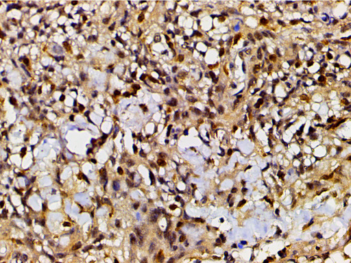 EFNB2 / Ephrin B2 Antibody - 1:200 staining human meningeal carcinomatosis(MC) tissue by IHC-P. The tissue was formaldehyde fixed and a heat mediated antigen retrieval step in citrate buffer was performed. The tissue was then blocked and incubated with the antibody for 1.5 hours at 22°C. An HRP conjugated goat anti-rabbit antibody was used as the secondary.