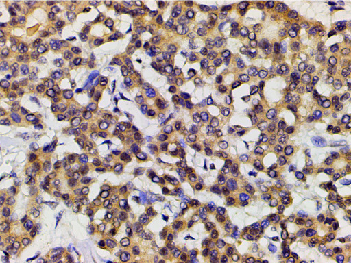 EFNB2 / Ephrin B2 Antibody - 1:200 staining human liver carcinoma tissues by IHC-P. The tissue was formaldehyde fixed and a heat mediated antigen retrieval step in citrate buffer was performed. The tissue was then blocked and incubated with the antibody for 1.5 hours at 22°C. An HRP conjugated goat anti-rabbit antibody was used as the secondary.