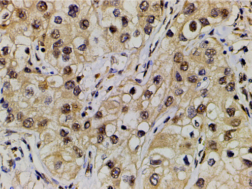 EFNB2 / Ephrin B2 Antibody - 1:200 staining human renal clear cells carcinoma tissue by IHC-P. The tissue was formaldehyde fixed and a heat mediated antigen retrieval step in citrate buffer was performed. The tissue was then blocked and incubated with the antibody for 1.5 hours at 22°C. An HRP conjugated goat anti-rabbit antibody was used as the secondary.