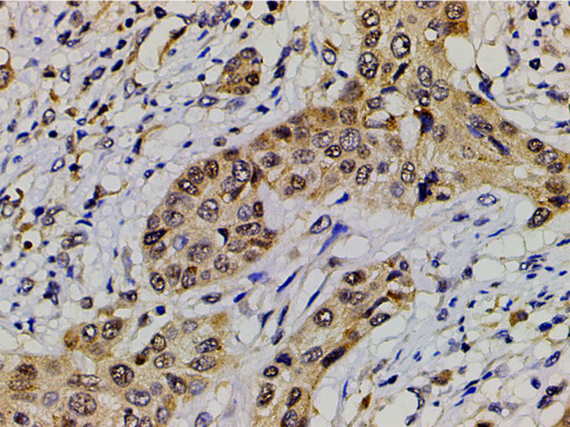 EFNB2 / Ephrin B2 Antibody - 1:200 staining human esophageal carcinoma tissue by IHC-P. The tissue was formaldehyde fixed and a heat mediated antigen retrieval step in citrate buffer was performed. The tissue was then blocked and incubated with the antibody for 1.5 hours at 22°C. An HRP conjugated goat anti-rabbit antibody was used as the secondary.