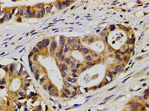 EFNB2 / Ephrin B2 Antibody - 1:200 staining human colon carcinoma tissue by IHC-P. The tissue was formaldehyde fixed and a heat mediated antigen retrieval step in citrate buffer was performed. The tissue was then blocked and incubated with the antibody for 1.5 hours at 22°C. An HRP conjugated goat anti-rabbit antibody was used as the secondary.