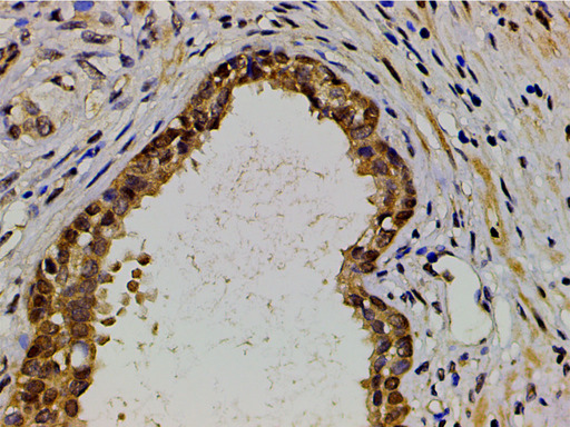 EFNB2 / Ephrin B2 Antibody - 1:200 staining human myosarcoma tissue by IHC-P. The tissue was formaldehyde fixed and a heat mediated antigen retrieval step in citrate buffer was performed. The tissue was then blocked and incubated with the antibody for 1.5 hours at 22°C. An HRP conjugated goat anti-rabbit antibody was used as the secondary.
