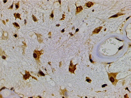 EFNB2 / Ephrin B2 Antibody - 1:200 staining human cholangiocarcinoma tissue by IHC-P. The tissue was formaldehyde fixed and a heat mediated antigen retrieval step in citrate buffer was performed. The tissue was then blocked and incubated with the antibody for 1.5 hours at 22°C. An HRP conjugated goat anti-rabbit antibody was used as the secondary.