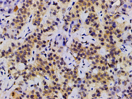 EFNB2 / Ephrin B2 Antibody - 1:200 staining human duodenum carcinoma tissue by IHC-P. The tissue was formaldehyde fixed and a heat mediated antigen retrieval step in citrate buffer was performed. The tissue was then blocked and incubated with the antibody for 1.5 hours at 22°C. An HRP conjugated goat anti-rabbit antibody was used as the secondary.