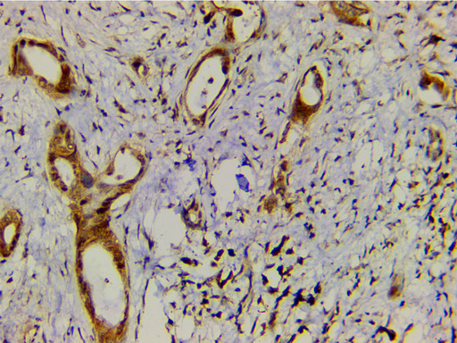 EFNB2 / Ephrin B2 Antibody - 1:200 staining human cholangiocarcinoma tissue by IHC-P. The tissue was formaldehyde fixed and a heat mediated antigen retrieval step in citrate buffer was performed. The tissue was then blocked and incubated with the antibody for 1.5 hours at 22°C. An HRP conjugated goat anti-rabbit antibody was used as the secondary.
