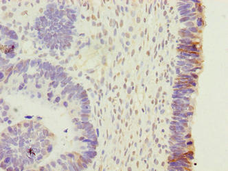 EFR3B Antibody - Immunohistochemistry of paraffin-embedded human ovarian cancer using EFR3B Antibody at dilution of 1:100