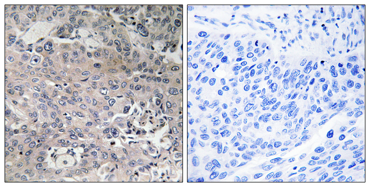 EFTU / TUFM Antibody - Immunohistochemistry analysis of paraffin-embedded human breast carcinoma tissue, using TUFM Antibody. The picture on the right is blocked with the synthesized peptide.
