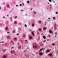 EFTU / TUFM Antibody - Immunohistochemical analysis of TUFM staining in human liver cancer formalin fixed paraffin embedded tissue section. The section was pre-treated using heat mediated antigen retrieval with sodium citrate buffer (pH 6.0). The section was then incubated with the antibody at room temperature and detected with HRP and AEC as chromogen. The section was then counterstained with hematoxylin and mounted with DPX.