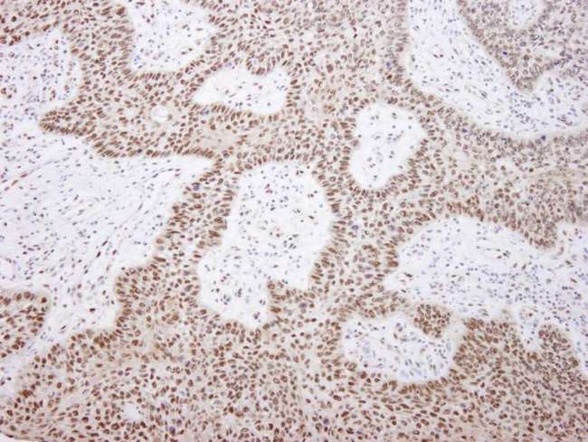 EFTUD2 Antibody - Detection of Human EFTUD2/SNRP116 by Immunohistochemistry. Sample: FFPE section of human laryngeal squamous cell carcinoma. Antibody: Affinity purified rabbit anti-EFTUD2/SNRP116 used at a dilution of 1:100.