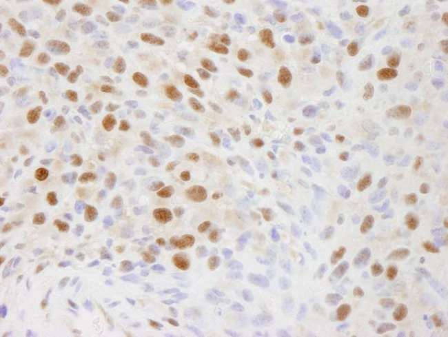 EFTUD2 Antibody - Detection of Mouse EFTUD2/SNRP116 by Immunohistochemistry. Sample: FFPE section of mouse squamous cell carcinoma. Antibody: Affinity purified rabbit anti-EFTUD2/SNRP116 used at a dilution of 1:100.