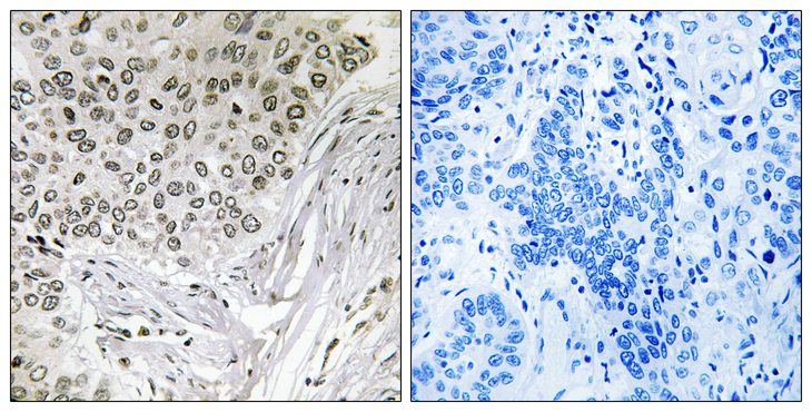 EFTUD2 Antibody - Immunohistochemistry analysis of paraffin-embedded human lung carcinoma tissue, using EFTUD2 Antibody. The picture on the right is blocked with the synthesized peptide.