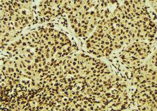 EFTUD2 Antibody - 1:100 staining human breast carcinoma tissue by IHC-P. The sample was formaldehyde fixed and a heat mediated antigen retrieval step in citrate buffer was performed. The sample was then blocked and incubated with the antibody for 1.5 hours at 22°C. An HRP conjugated goat anti-rabbit antibody was used as the secondary.