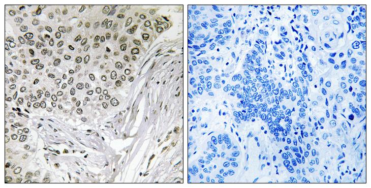 EFTUD2 Antibody - Peptide - + Immunohistochemistry analysis of paraffin-embedded human lung carcinoma tissue, using EFTUD2 antibody.