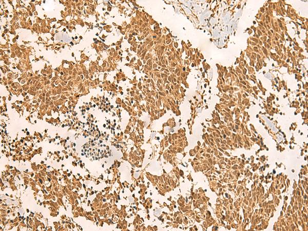 EFTUD2 Antibody - Immunohistochemistry of paraffin-embedded Human lung cancer tissue  using EFTUD2 Polyclonal Antibody at dilution of 1:45(×200)
