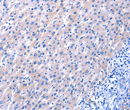 EGF Antibody - Immunohistochemistry of paraffin-embedded human liver cancer tissue using EGF antibody.