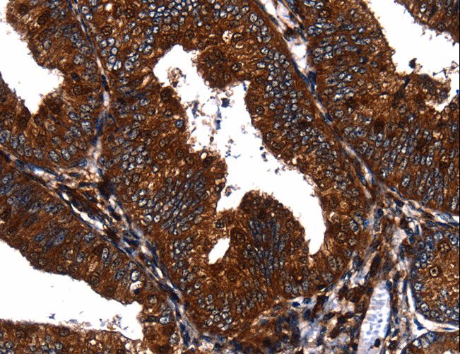 EGF Antibody - Immunohistochemistry of paraffin-embedded Human cervical cancer using EGF Polyclonal Antibody at dilution of 1:60.