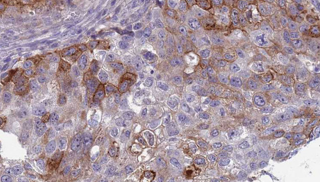 EGF Antibody - 1:100 staining human urothelial carcinoma tissue by IHC-P. The sample was formaldehyde fixed and a heat mediated antigen retrieval step in citrate buffer was performed. The sample was then blocked and incubated with the antibody for 1.5 hours at 22°C. An HRP conjugated goat anti-rabbit antibody was used as the secondary.