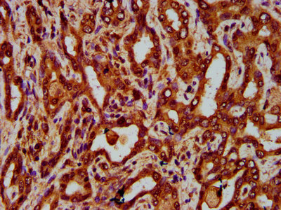 EGFL7 Antibody - Immunohistochemistry Dilution at 1:300 and staining in paraffin-embedded human liver cancer performed on a Leica BondTM system. After dewaxing and hydration, antigen retrieval was mediated by high pressure in a citrate buffer (pH 6.0). Section was blocked with 10% normal Goat serum 30min at RT. Then primary antibody (1% BSA) was incubated at 4°C overnight. The primary is detected by a biotinylated Secondary antibody and visualized using an HRP conjugated SP system.