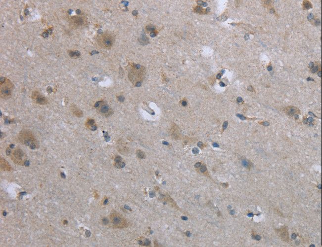 EGFL8 / NG3 Antibody - Immunohistochemistry of paraffin-embedded Human thyroid cancer using EGFL8 Polyclonal Antibody at dilution of 1:40.