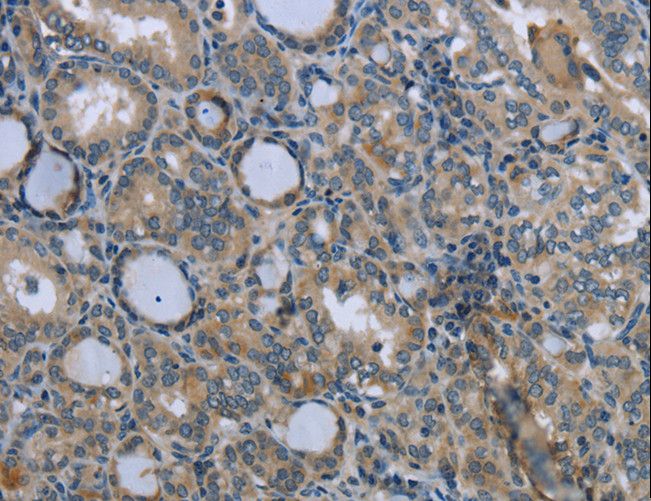 EGFL8 / NG3 Antibody - Immunohistochemistry of paraffin-embedded Human thyroid cancer using EGFL8 Polyclonal Antibody at dilution of 1:40.