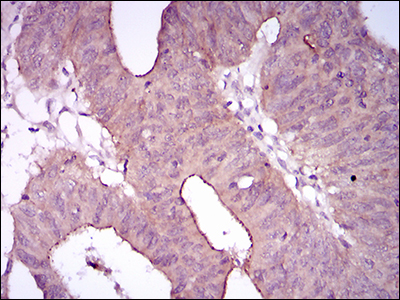 EGFR Antibody - IHC of paraffin-embedded rectum cancer tissues using EGFR mutant mouse monoclonal antibody with DAB staining.