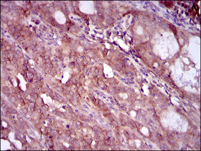 EGFR Antibody - IHC of paraffin-embedded cervical cancer tissues using EGFR mutant mouse monoclonal antibody with DAB staining.