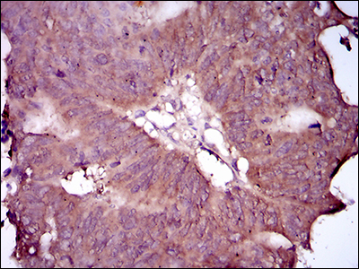 EGFR Antibody - IHC of paraffin-embedded rectum cancer tissues using EGFR mutant mouse monoclonal antibody with DAB staining.