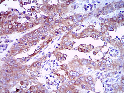 EGFR Antibody - IHC of paraffin-embedded endometrial cancer tissues using EGFR mouse monoclonal antibody with DAB staining.