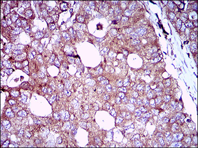 EGFR Antibody - IHC of paraffin-embedded esophageal cancer tissues using EGFR mouse monoclonal antibody with DAB staining.