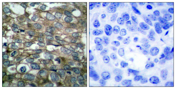 EGFR Antibody - Immunohistochemistry analysis of paraffin-embedded human breast carcinoma tissue, using EGFR Antibody. The picture on the right is blocked with the synthesized peptide.