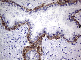 EGFR Antibody - IHC of paraffin-embedded Carcinoma of Human prostate tissue using anti-EGFR mouse monoclonal antibody. (Heat-induced epitope retrieval by 10mM citric buffer, pH6.0, 120°C for 3min).