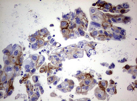 EGFR Antibody - IHC of paraffin-embedded Carcinoma of Human bladder tissue using anti-EGFR mouse monoclonal antibody. (Heat-induced epitope retrieval by 10mM citric buffer, pH6.0, 120°C for 3min).