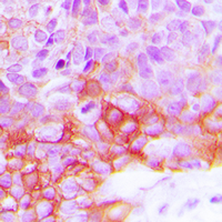 EGFR Antibody - Immunohistochemical analysis of EGFR (pY1092) staining in human breast cancer formalin fixed paraffin embedded tissue section. The section was pre-treated using heat mediated antigen retrieval with sodium citrate buffer (pH 6.0). The section was then incubated with the antibody at room temperature and detected using an HRP conjugated compact polymer system. DAB was used as the chromogen. The section was then counterstained with hematoxylin and mounted with DPX.