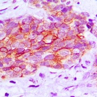 EGFR Antibody - Immunohistochemical analysis of EGFR (pY1016) staining in human prostate cancer formalin fixed paraffin embedded tissue section. The section was pre-treated using heat mediated antigen retrieval with sodium citrate buffer (pH 6.0). The section was then incubated with the antibody at room temperature and detected with HRP and DAB as chromogen. The section was then counterstained with hematoxylin and mounted with DPX.