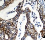 EGFR Antibody - IHC of EGFR on FFPE Colon Carcinoma tissue. This image was taken for the unmodified form of this product. Other forms have not been tested.