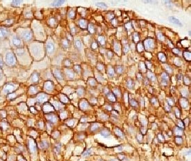 EGFR Antibody - IHC testing of lung squamous cell carcinoma stained with EGFR antibody (ERB59-1).  This image was taken for the unmodified form of this product. Other forms have not been tested.