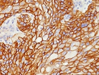 EGFR Antibody - IHC testing of FFPE human lung squamous cell carcinoma with EGF Receptor antibody (clone GFR/1708). Required HIER: boiling tissue sections in 10mM citrate buffer, pH 6, for 10-20 min.