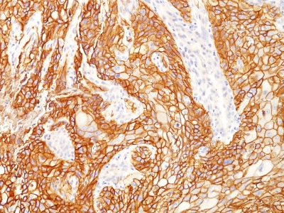 EGFR Antibody - Formalin-fixed, paraffin-embedded human Lung SqCC stained with EGFRvIII Rabbit Recombinant Monoclonal Antibody (GFR/2600R).