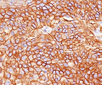 EGFR Antibody - EGFR antibody GFR450 immunohistochemistry.  This image was taken for the unmodified form of this product. Other forms have not been tested.